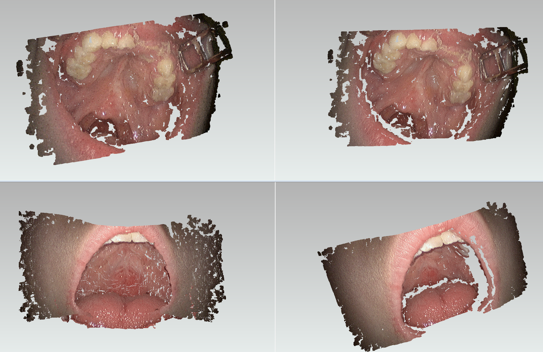 Reconstruction of an oral cavity
